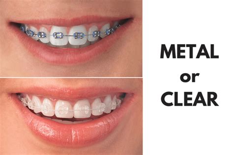 clear bracket braces vs metal|invisible braces vs metal.